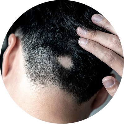 Alopecia Areata