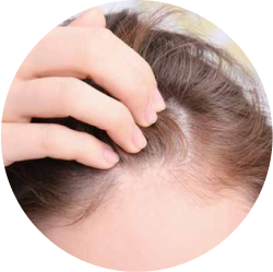 Diffuse Alopecia