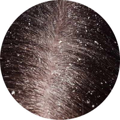 Dry Dandruff