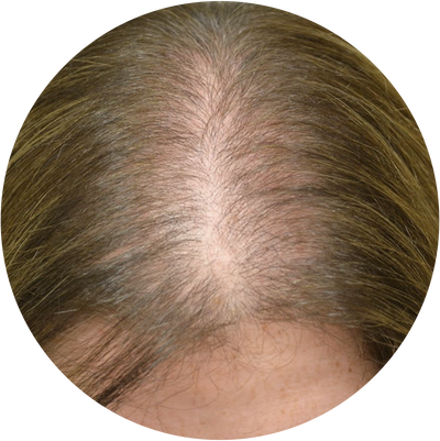 Female Androgenetic Alopecia