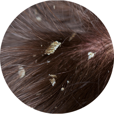 Oily Dandruff