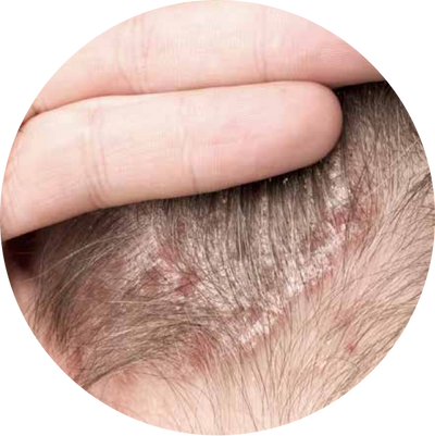 Psoriasis