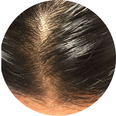 Seborrhea
