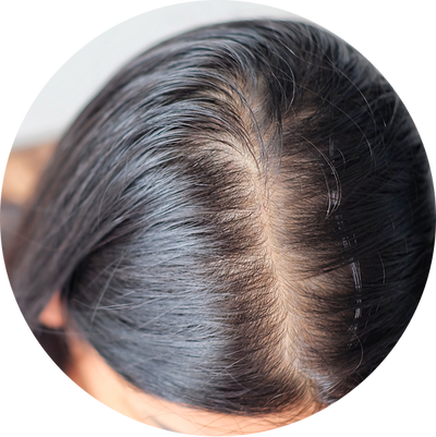Thyroid-Related Alopecia
